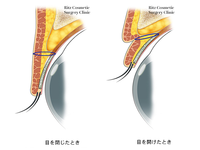 3点固定法断面図