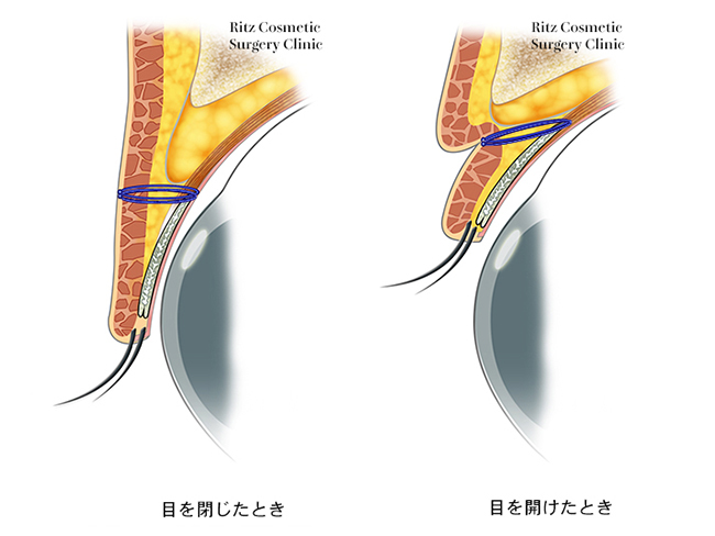 6点固定法断面図