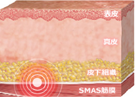 SMAS筋膜にHIFUを照射できるのは医療機関のみ