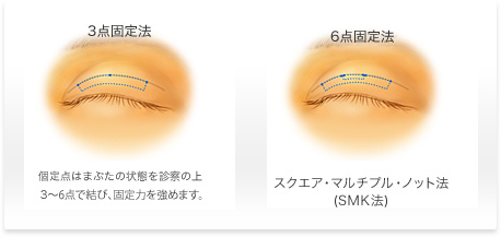 埋没法
