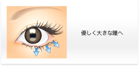 下眼瞼下制術