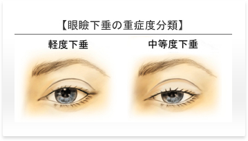 眼瞼下垂